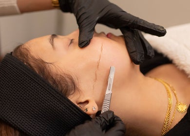 Dermaplaning at The Vancouver Aesthetician - Lower Lonsdale, North Vancouver, British Columbia, CA.