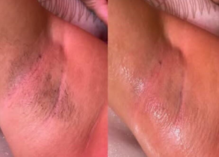 Before and after waxing results at My Candy Wax, River Grove, Illinois, US, showcasing smooth skin.