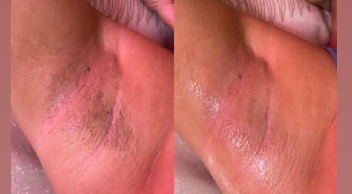 Before and after waxing results at My Candy Wax, River Grove, Illinois, US, showcasing smooth skin.