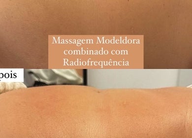 Antes e depois de massagem modeladora com radiofrequência no Andreia Flores Beauty, Fradelos, Braga, PT.