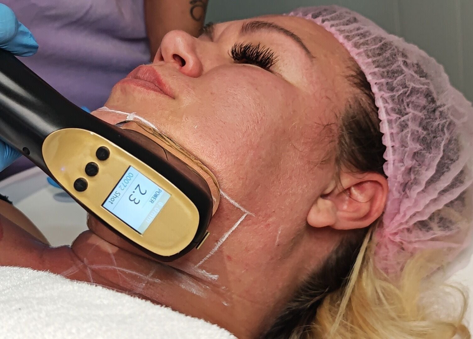 Процедура радиочастотного лифтинга в Effect Studio, Фаро, Фаро, PT для подтяжки кожи.