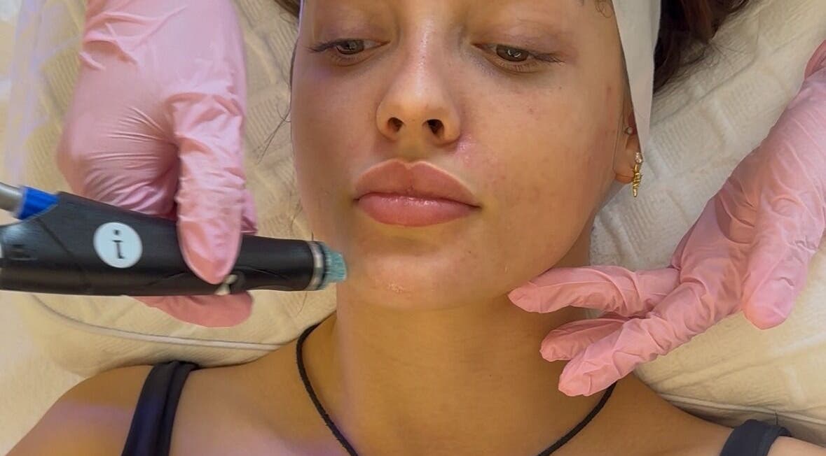 Hydrafacial treatment at Ethereal Aesthetics, London, England, GB, for rejuvenated skin.