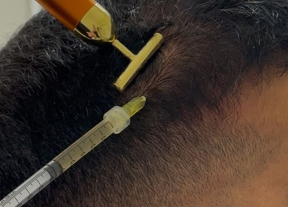 Hair treatment at Ethereal Aesthetics, London, England, GB, showcasing a scalp rejuvenation process.