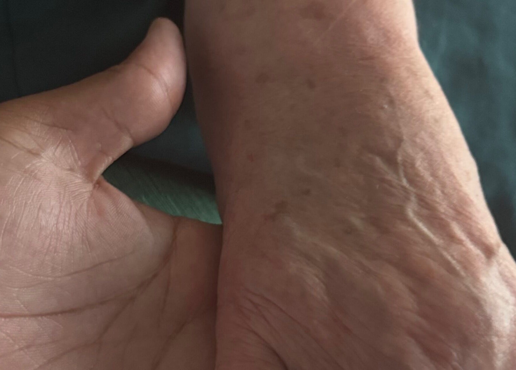 Mãos recebendo tratamento em Tratamentos Domiciliares, Almada, Setúbal, PT.