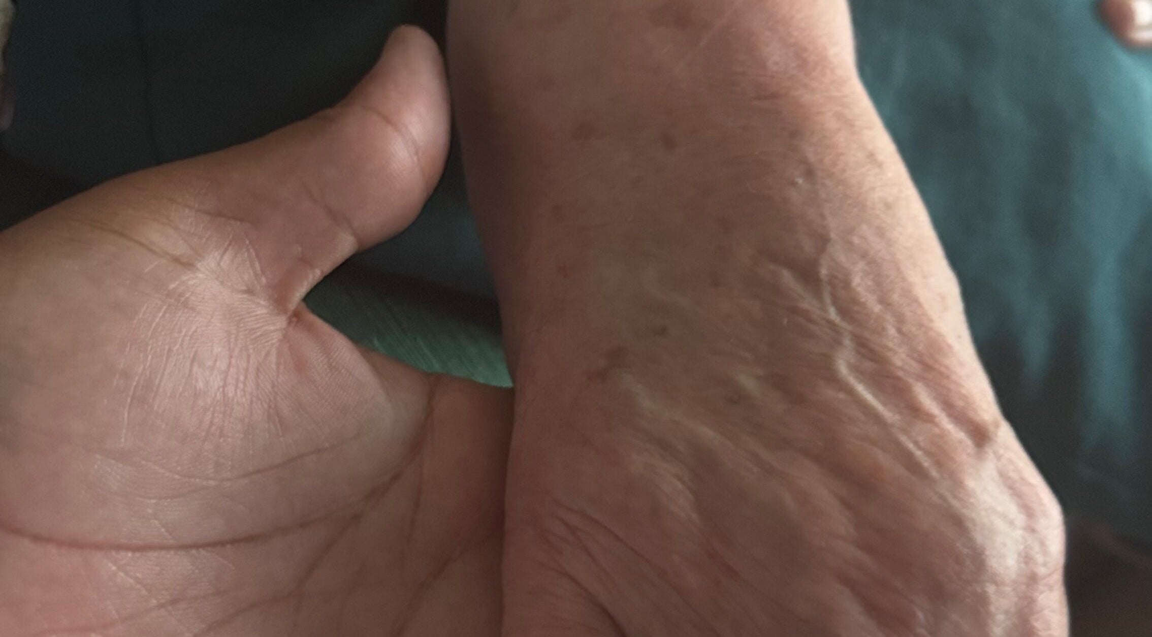 Mãos recebendo tratamento em Tratamentos Domiciliares, Almada, Setúbal, PT.