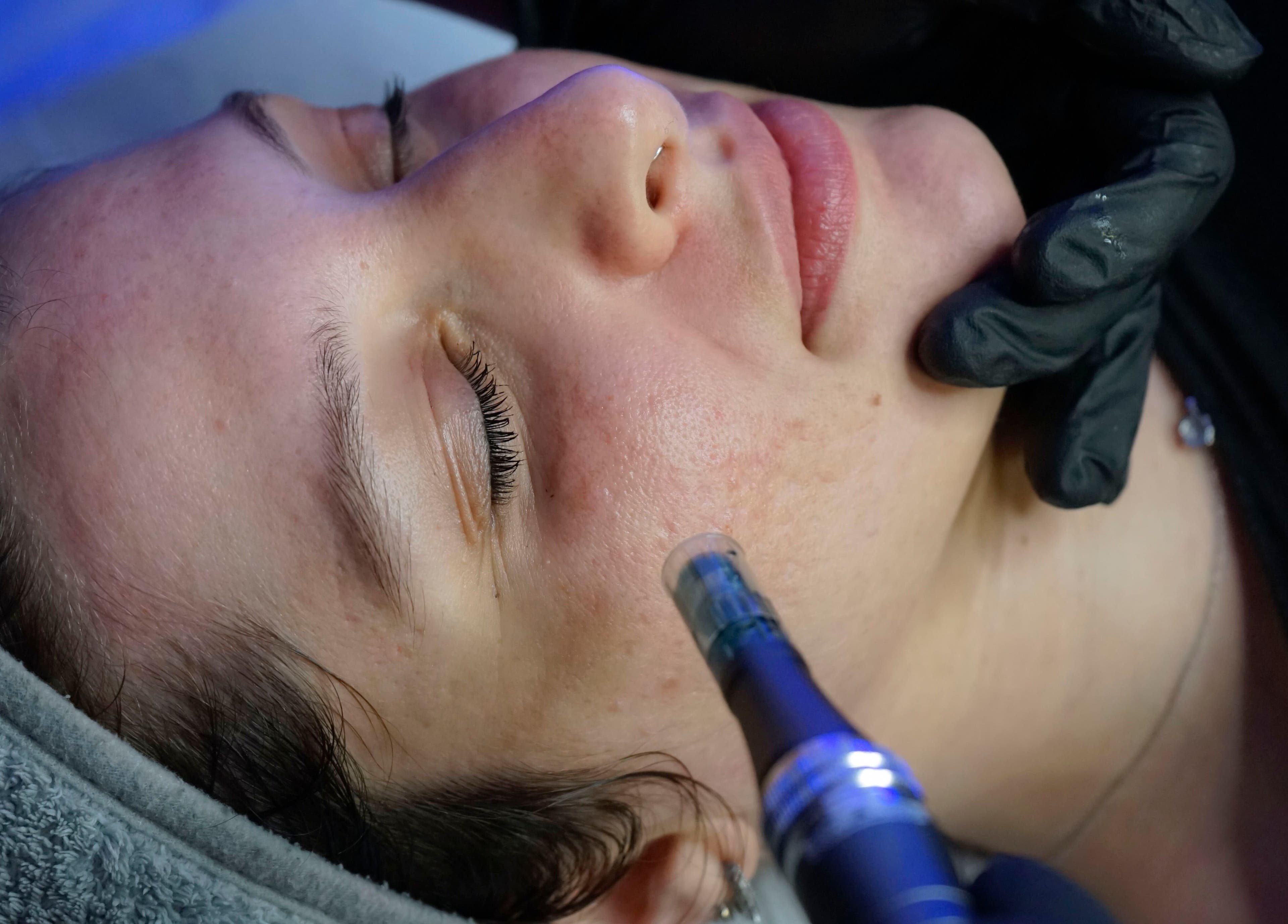 Facial treatment at Fine Line Studios, London, England, GB showcasing precise skincare techniques.