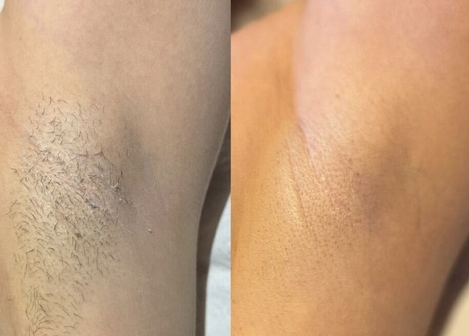 Before and after underarm hair removal at Illuminate Mobile Clinic, Bramley, England, GB.