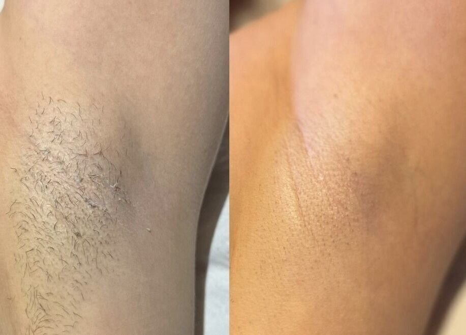 Before and after underarm hair removal at Illuminate Mobile Clinic, Bramley, England, GB.