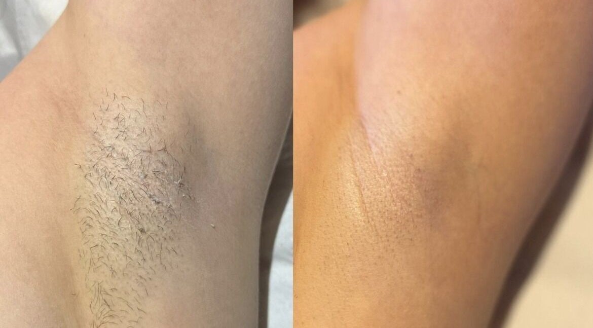 Before and after underarm hair removal at Illuminate Mobile Clinic, Bramley, England, GB.