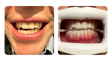 Simply Bright Teeth Whitening Gippsland image 3