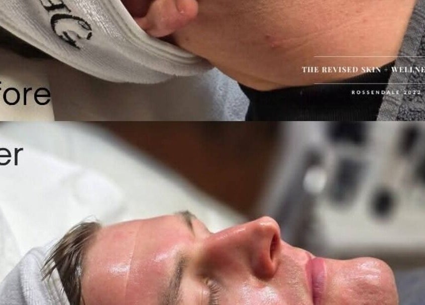 Before and after skin treatment at Mobile in Home appointment, Kidsgrove, England, GB.
