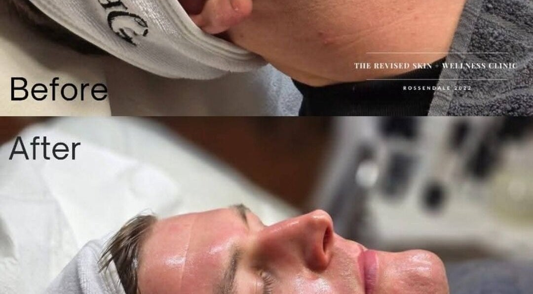 Before and after skin treatment at Mobile in Home appointment, Kidsgrove, England, GB.