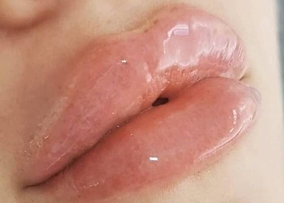 Close-up of glossy lips at Nordik Aesthetics @ Dahlin, Sandbach, England, GB showcasing beauty treatments.