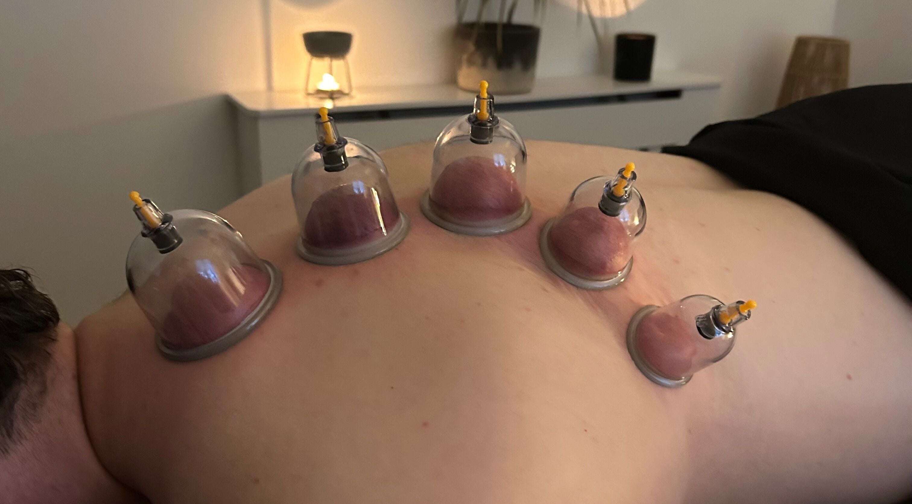 Cupping therapy session at PL Massage Therapy - Mobile Therapist, Mansfield, England, GB.