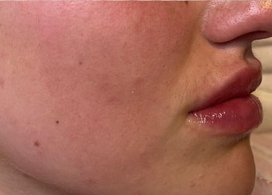 Close-up of a smooth, glowing complexion at Align Enhancements in Barry, Wales, GB.