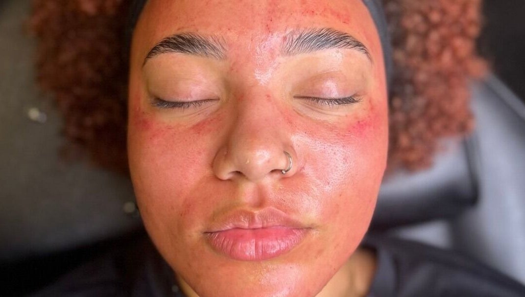 Facial treatment at AMORE Aesthetics in London, England, GB shows glowing, refreshed skin post-session.