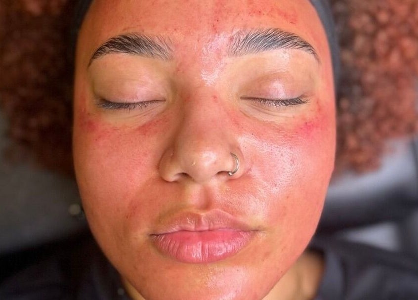 Facial treatment at AMORE Aesthetics in London, England, GB shows glowing, refreshed skin post-session.