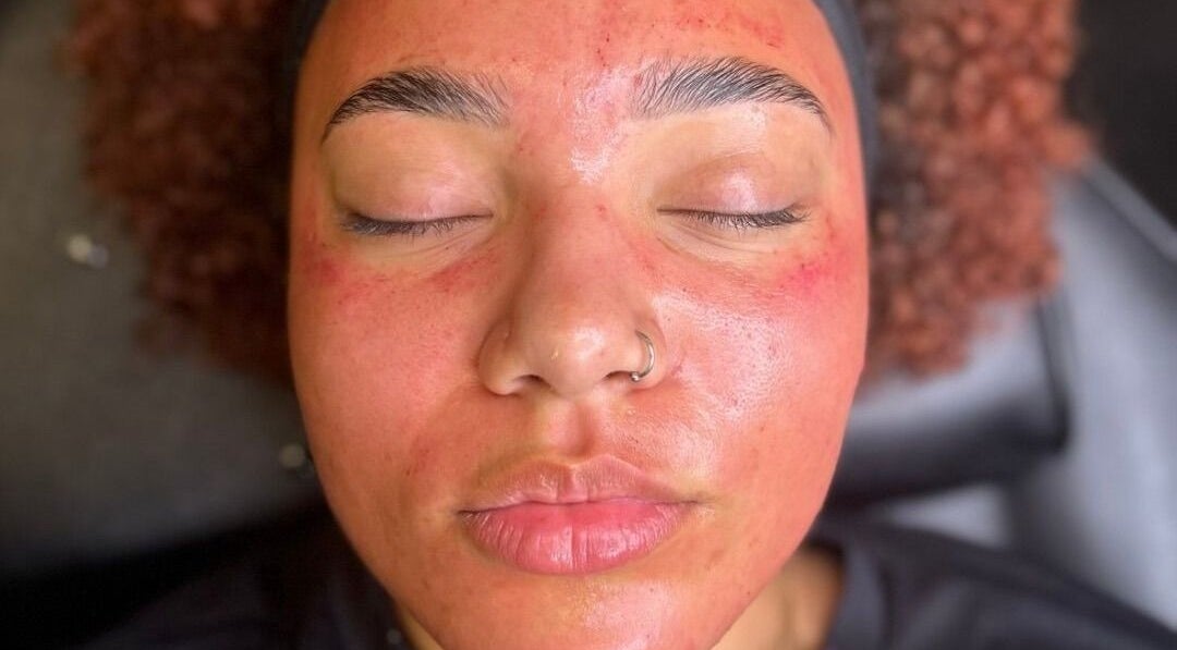 Facial treatment at AMORE Aesthetics in London, England, GB shows glowing, refreshed skin post-session.