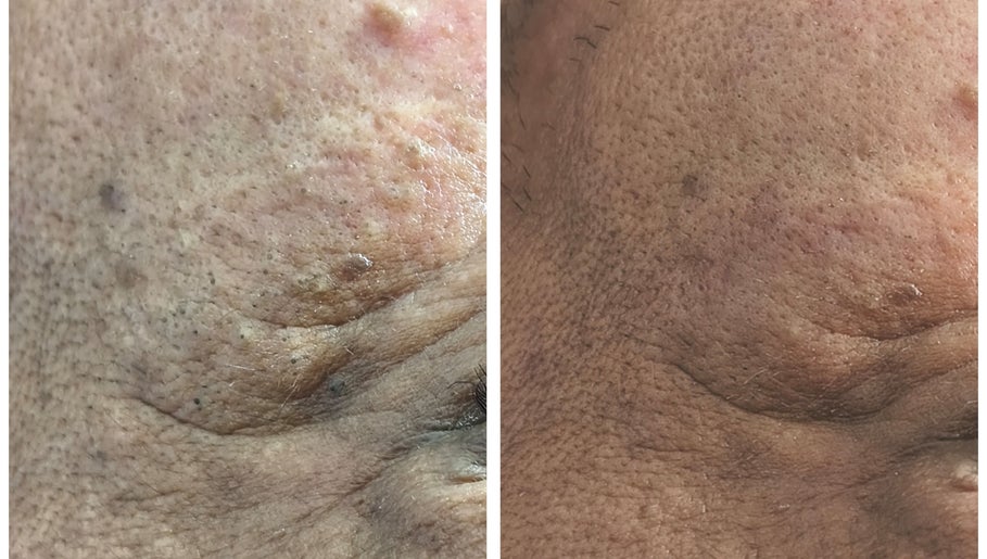 Resultados de tratamiento facial en Derma Nurse by Mariana Enfermería Cosmetología y Estética, La Florida, Región Metropolitana, CL.