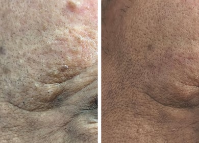 Resultados de tratamiento facial en Derma Nurse by Mariana Enfermería Cosmetología y Estética, La Florida, Región Metropolitana, CL.