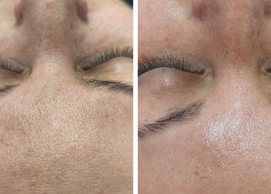 Tratamiento facial en Derma Nurse by Mariana en La Florida, Región Metropolitana, CL. Resultados visibles de piel mejorada.