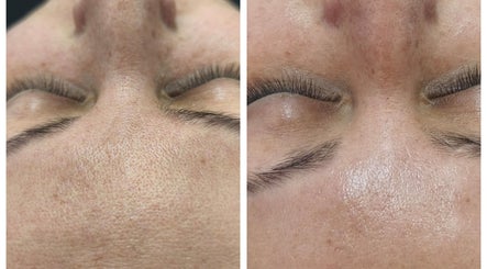 Tratamiento facial en Derma Nurse by Mariana en La Florida, Región Metropolitana, CL. Resultados visibles de piel mejorada.