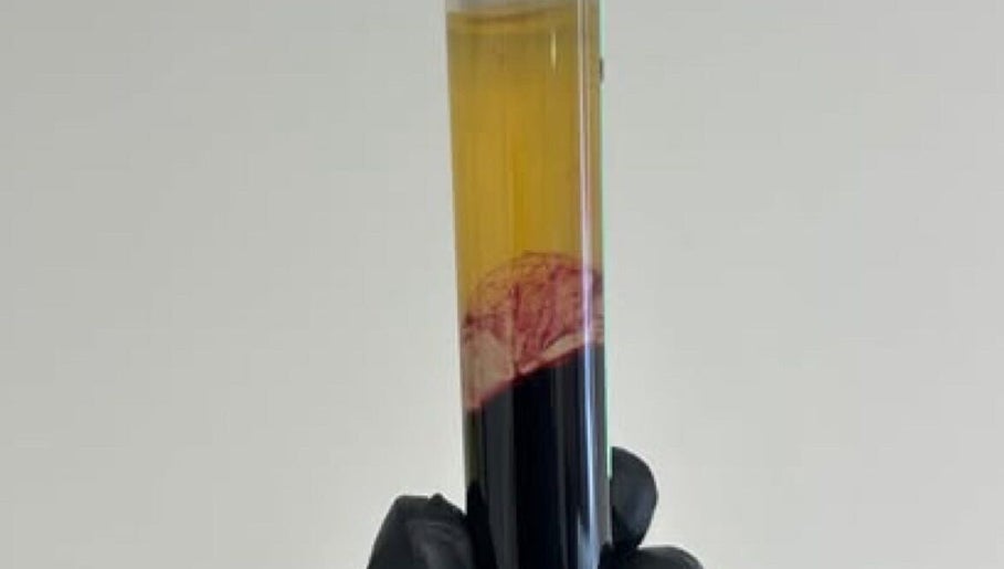 Blood sample preparation at SkinFluence clinic in Stalybridge, England, GB for advanced beauty treatments.