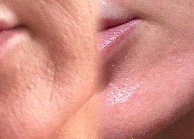 Close-up of smooth skin transformation at SkinFluence clinic, Stalybridge, England, GB.