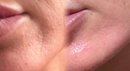 Close-up of smooth skin transformation at SkinFluence clinic, Stalybridge, England, GB.