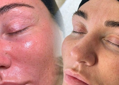 Close-up of glowing skin after treatment at SkinFluence clinic, Stalybridge, England, GB.