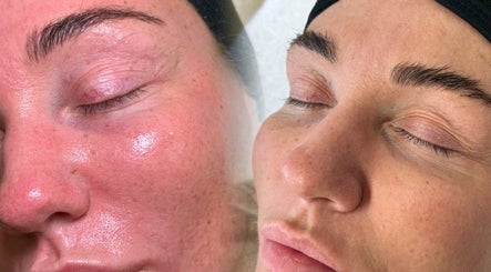 Close-up of glowing skin after treatment at SkinFluence clinic, Stalybridge, England, GB.