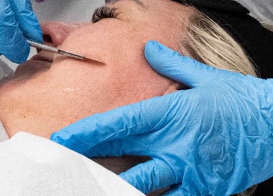 Professional dermaplaning session at Reflexions, Hockley, England, GB enhancing skin smoothness.