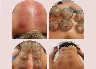 Cupping therapy at Mina Beauty & Massage, Mermaid Beach, Queensland, AU, enhancing blood flow and relaxation.