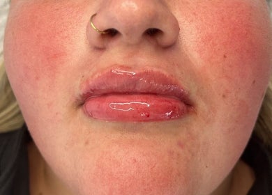 Lip enhancement at Beauty & Aesthetics By Lil, Bradford, England, GB showcasing glossy, plump lips.