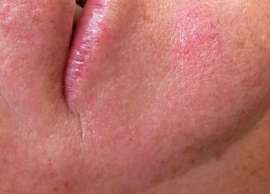 Close-up de pele facial saudável após tratamento no LuminaSpa, Aveiro, Aveiro, PT.
