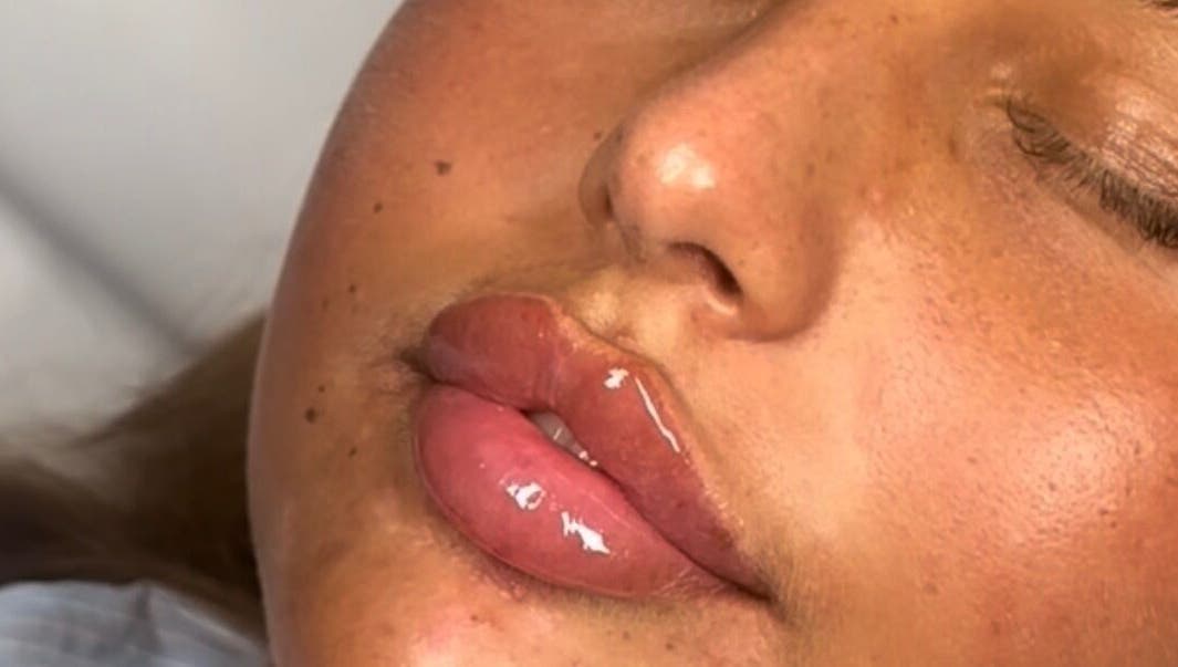 Close-up of glossy lips treatment at Jaesthetics in Upminster, England, GB.