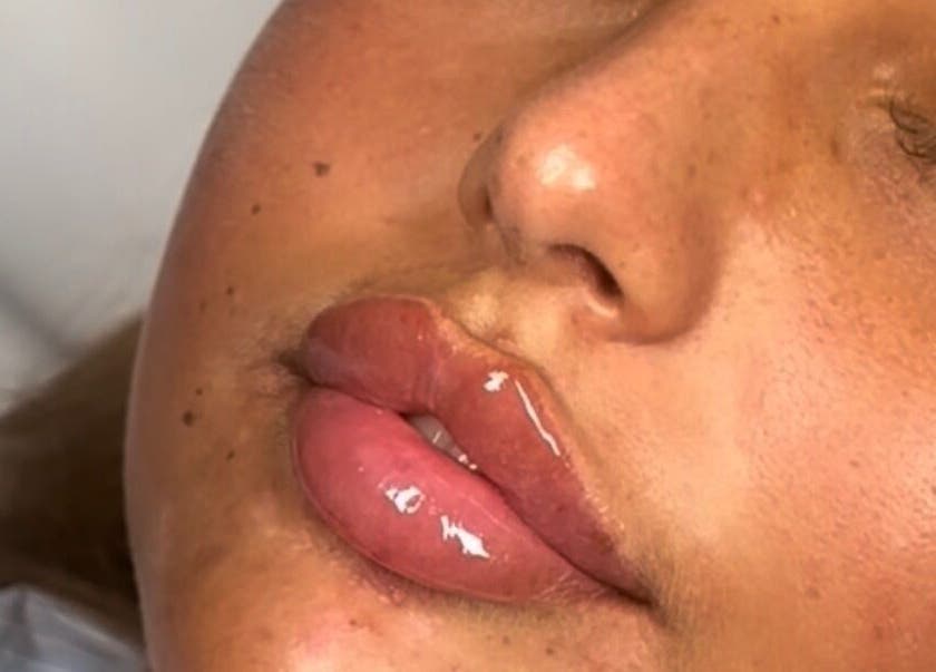 Close-up of glossy lips treatment at Jaesthetics in Upminster, England, GB.