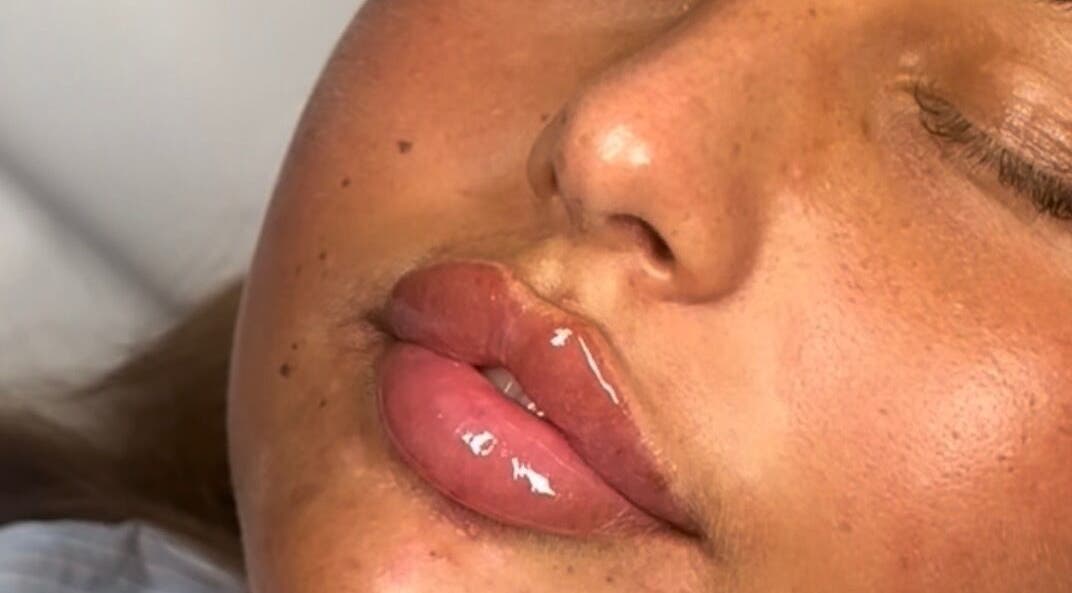 Close-up of glossy lips treatment at Jaesthetics in Upminster, England, GB.