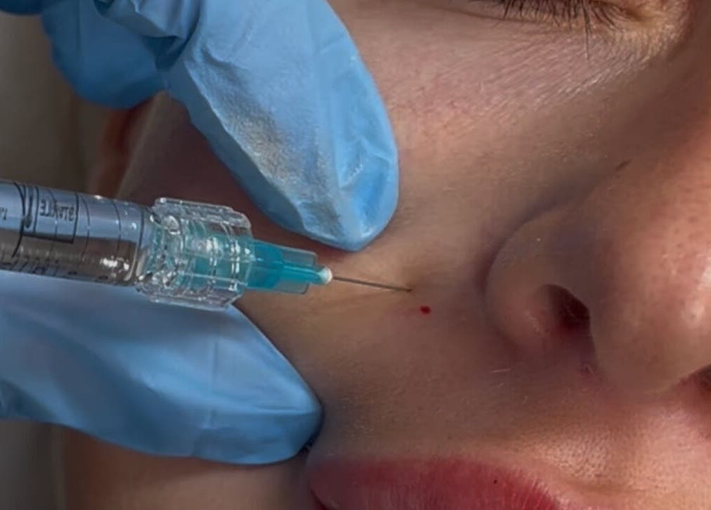 Dermal filler treatment at Jaesthetics in Upminster, England, GB, showcasing precision skincare.