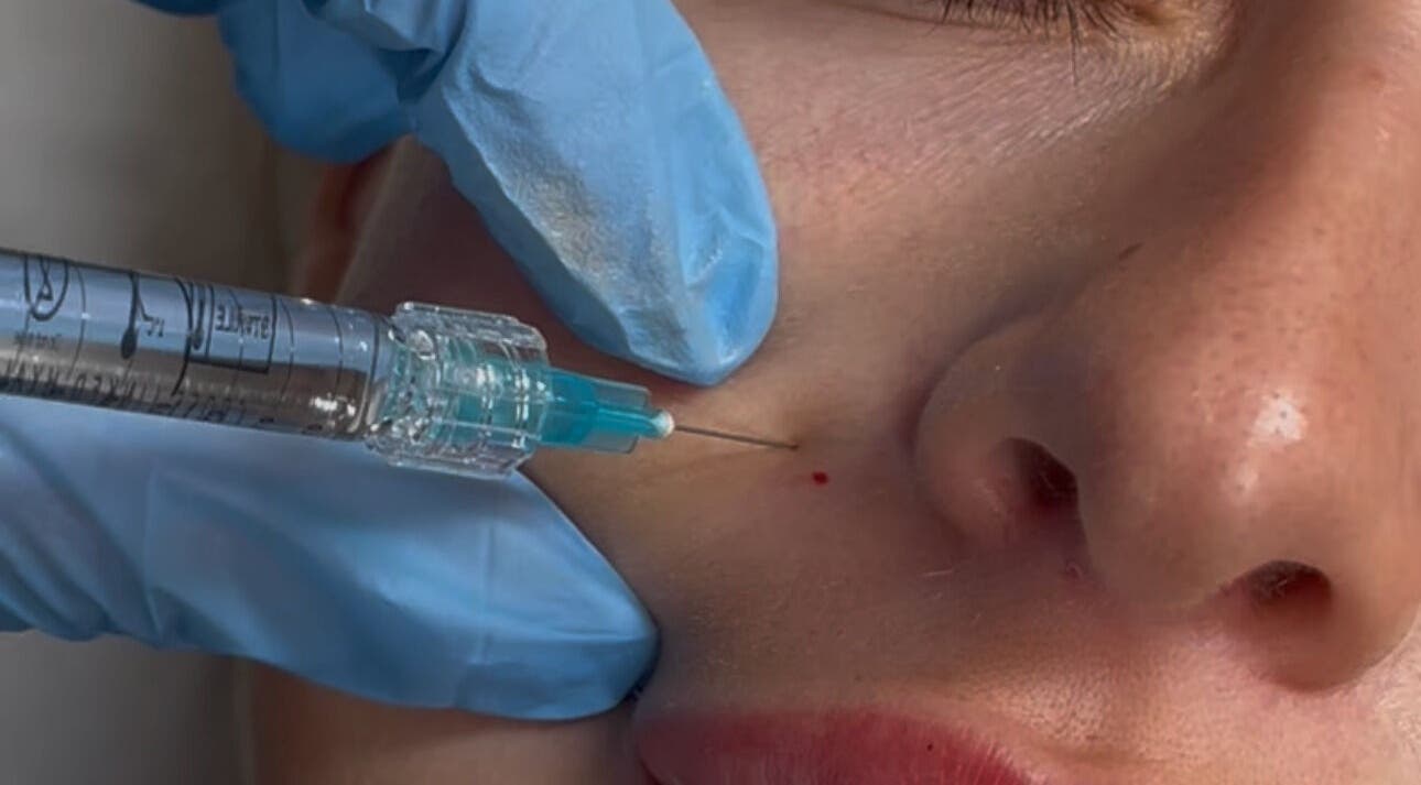 Dermal filler treatment at Jaesthetics in Upminster, England, GB, showcasing precision skincare.