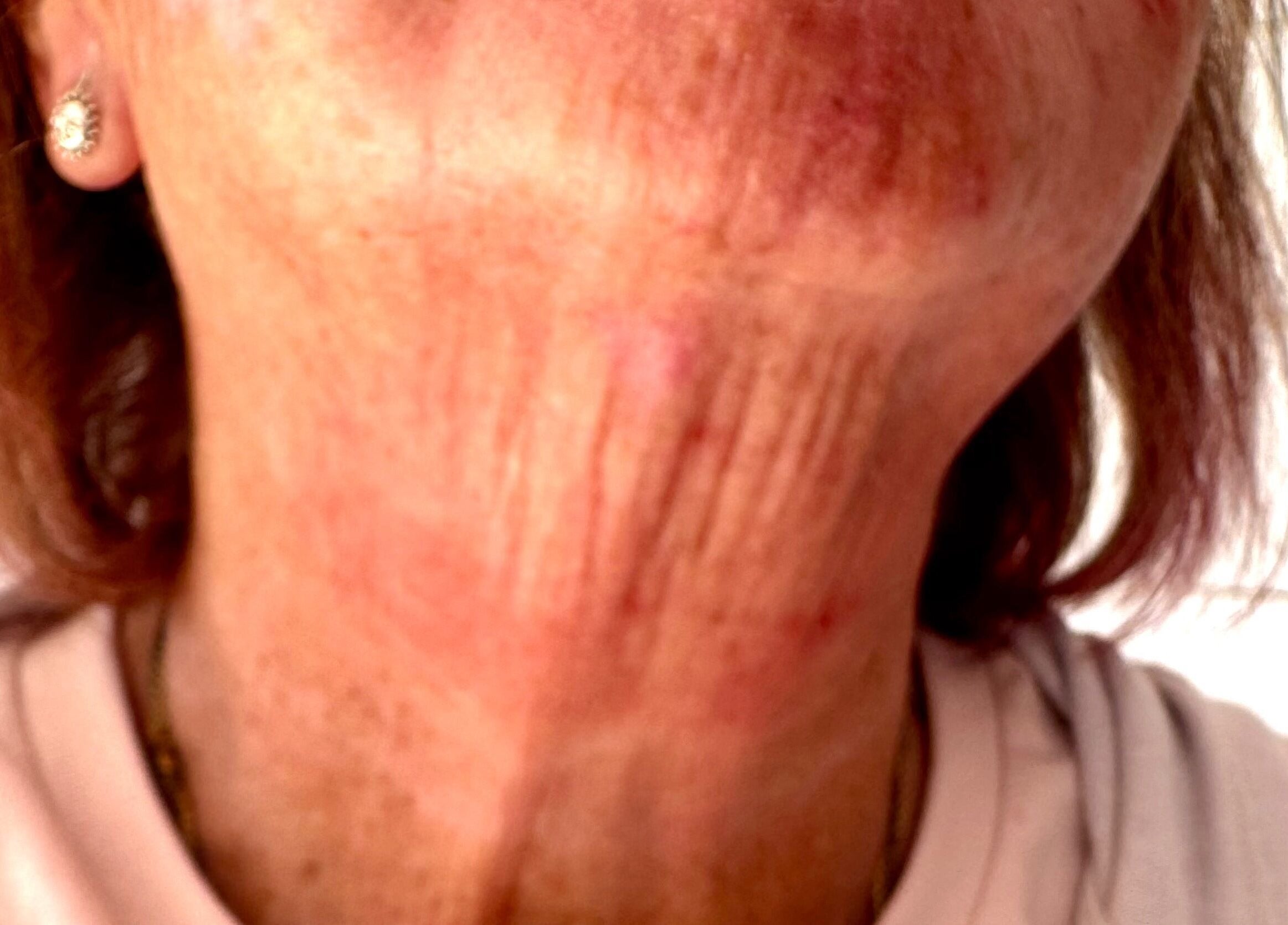 Rejuvenated neck treatment at Pixie Glow Aesthetics & Nails, Harlow, England, GB. Experience smoother skin.