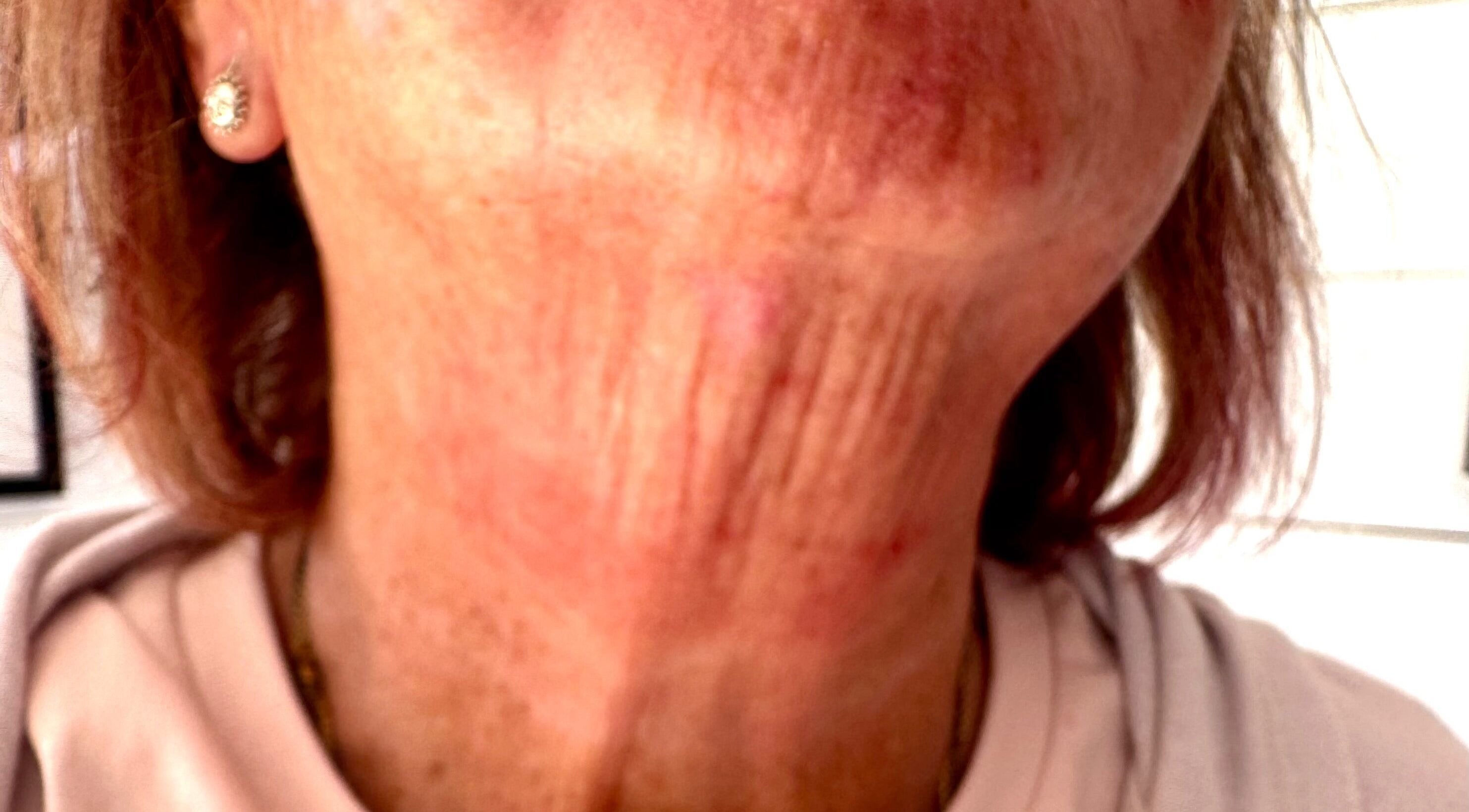 Rejuvenated neck treatment at Pixie Glow Aesthetics & Nails, Harlow, England, GB. Experience smoother skin.