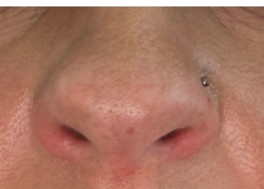 Close-up of nose skincare treatment at Pixie Glow Aesthetics & Nails in Harlow, England, GB.