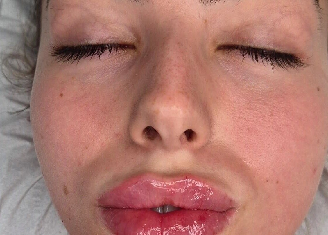 Close-up of lip treatment at Gemini Aesthetic, Royal Tunbridge Wells, England, GB; enhancing natural beauty.