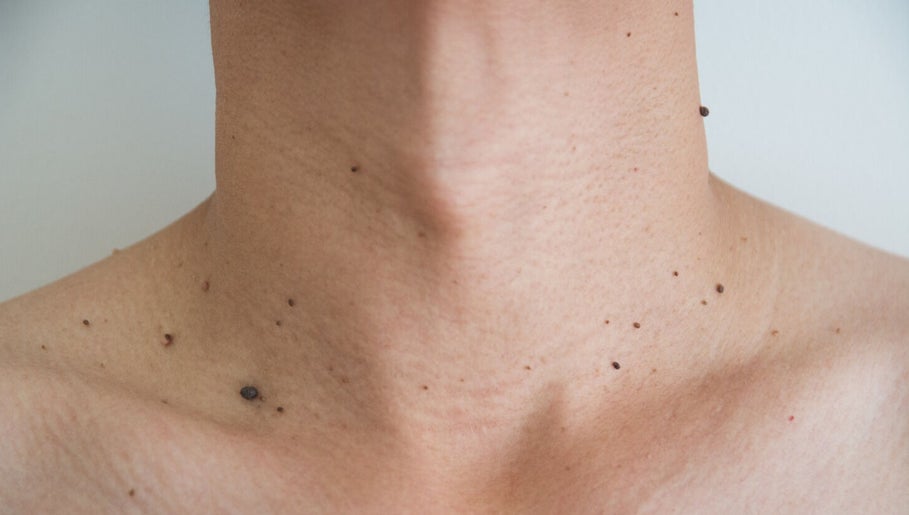 Tina Johnson Personal Aesthetics; Skin Tag and Blemish Removal in and around Maidstone image 1