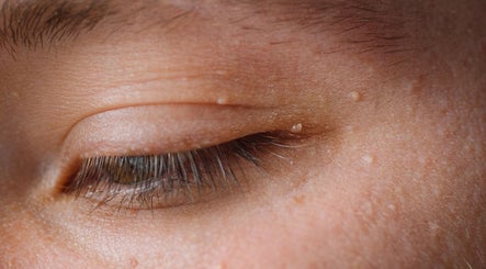 Tina Johnson Personal Aesthetics; Skin Tag and Blemish Removal in and around Maidstone image 2