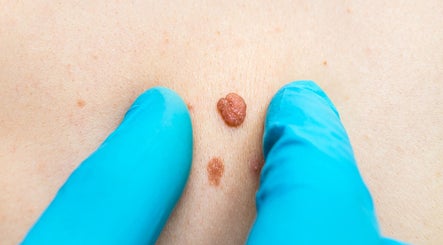 Tina Johnson Personal Aesthetics; Skin Tag and Blemish Removal in and around Maidstone image 3