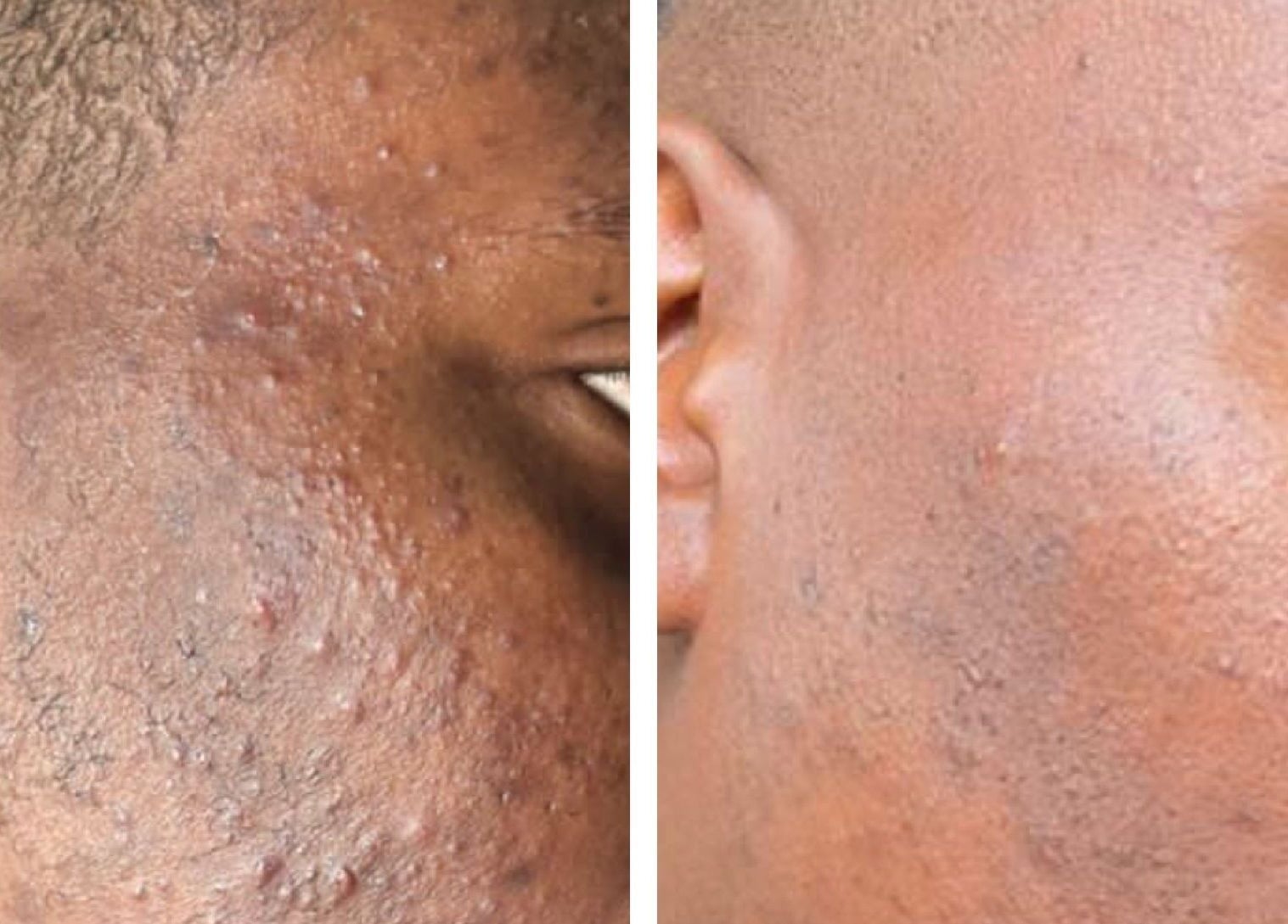 Before and after skin treatment at Zeekarh Cosmetics, Leeds, England, GB showcases visible acne reduction.