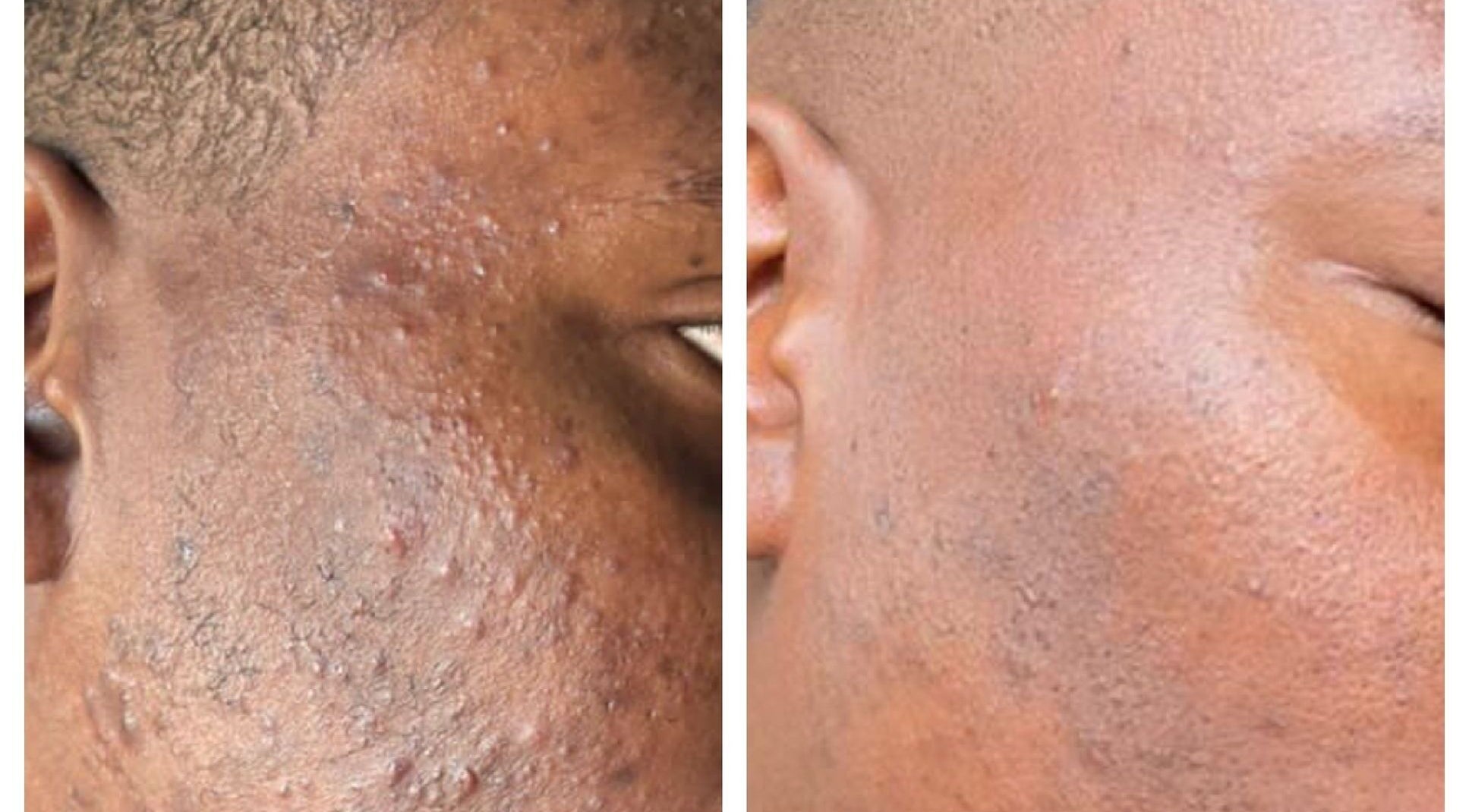Before and after skin treatment at Zeekarh Cosmetics, Leeds, England, GB showcases visible acne reduction.