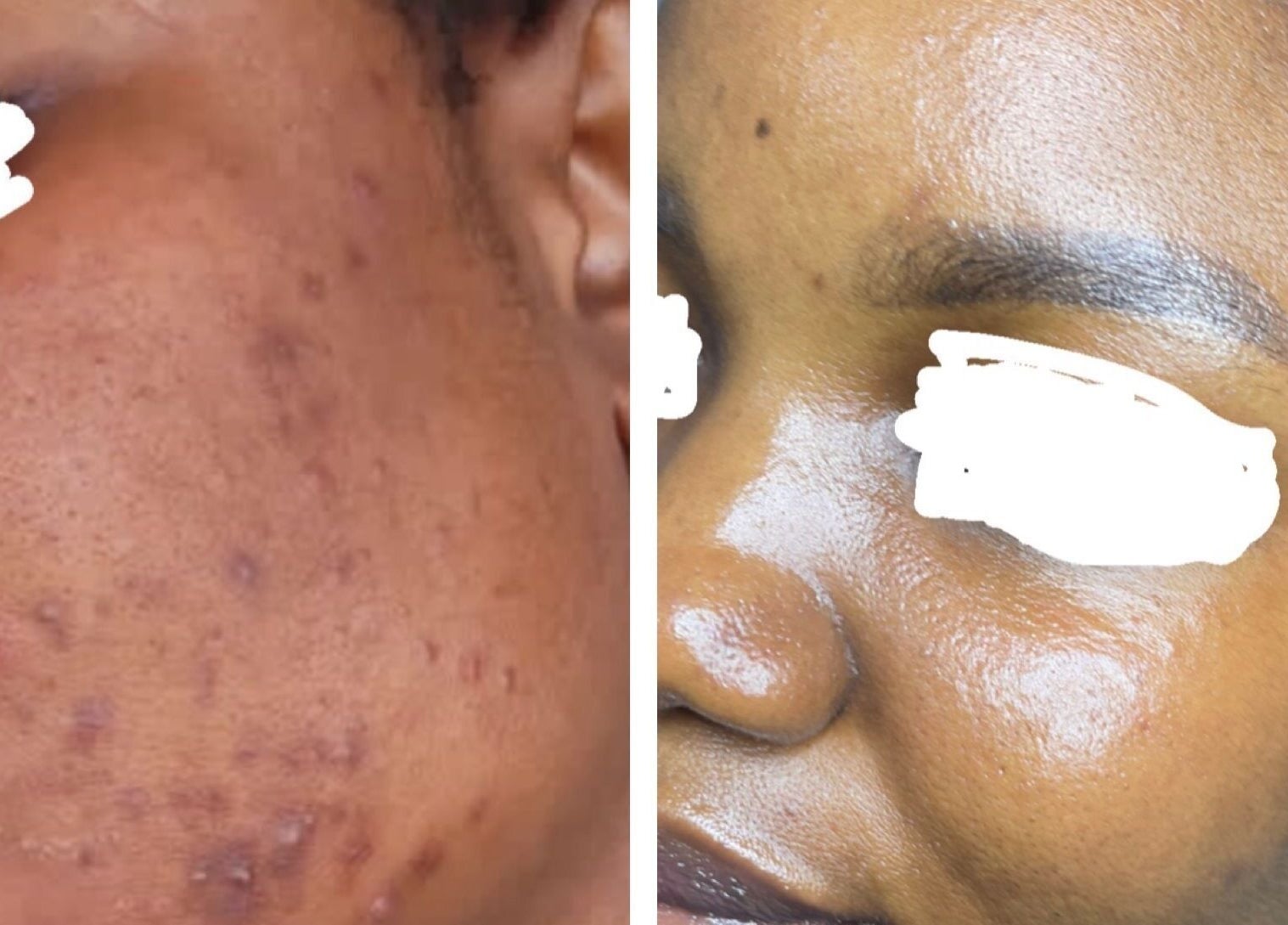 Before and after skin transformation at Zeekarh Cosmetics in Leeds, England, GB.